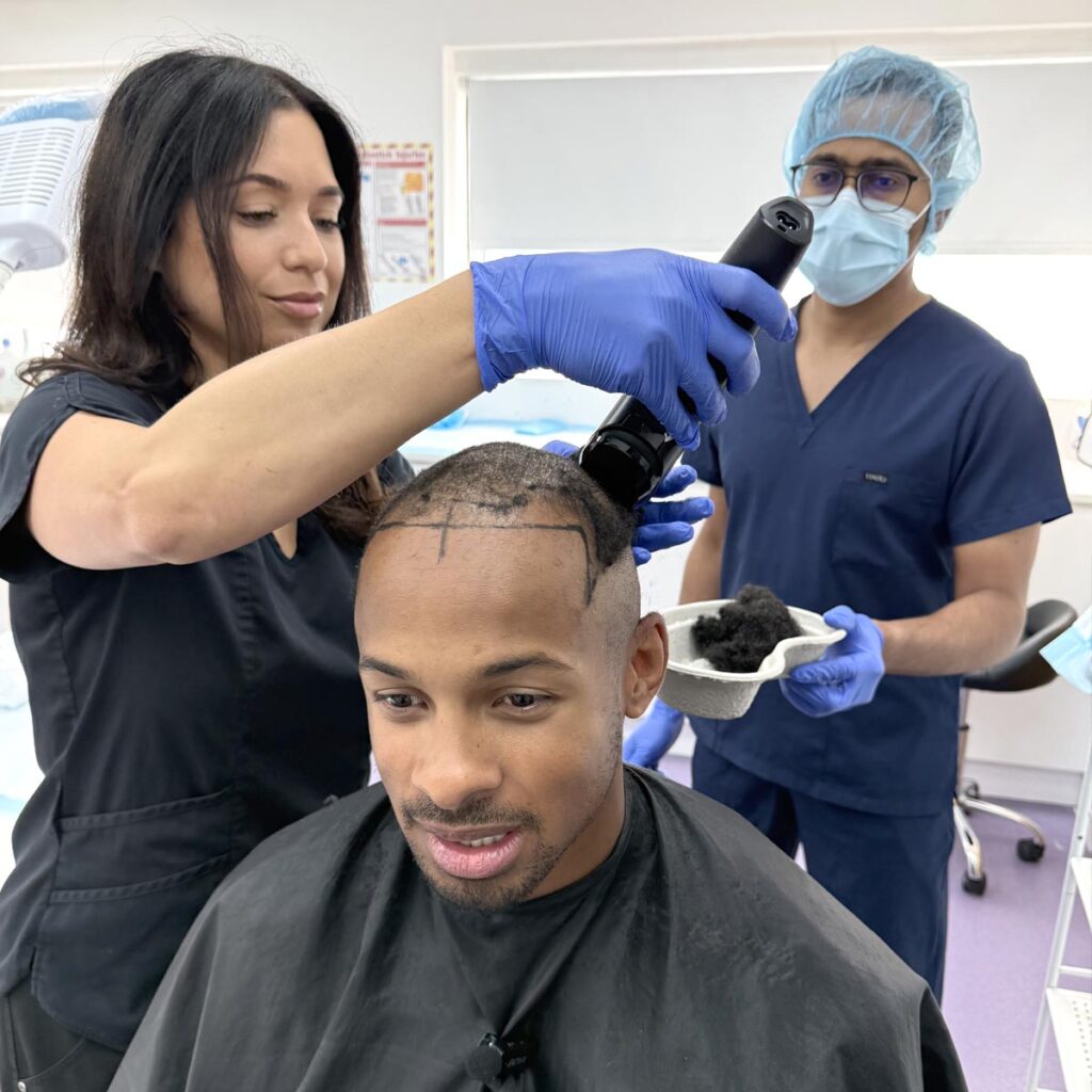 Afro Hair Transplant - Konnor Ewudzi - FUE Hair Transplant - British Hair Clinic