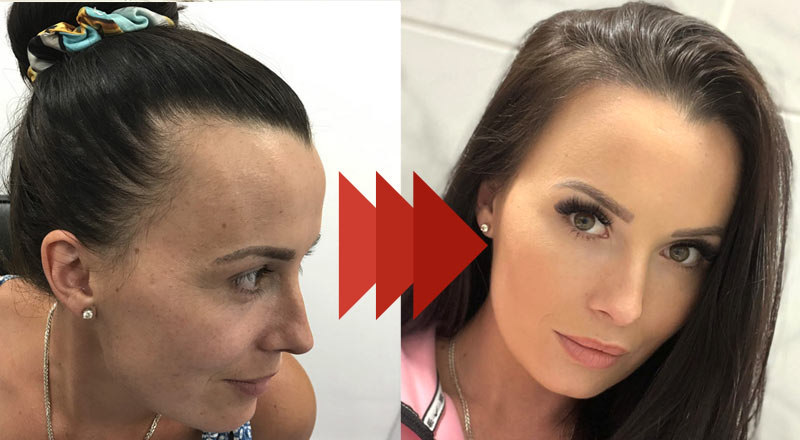 Best Women's Hair Transplant Specialists - Best Hair Clinic UK - UK - British Hair Clinic