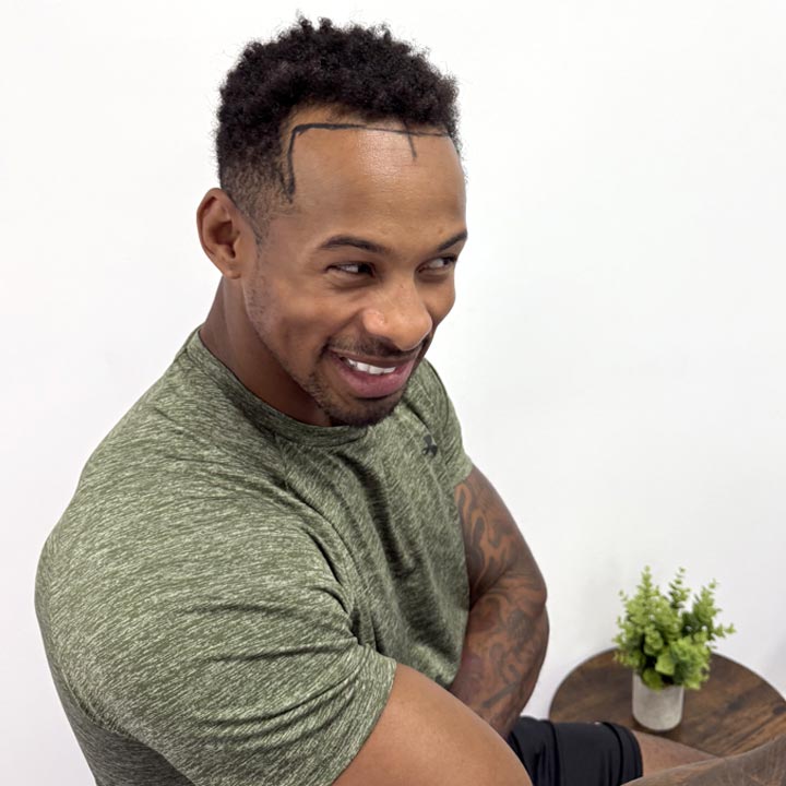 Celebrity Hair Transplant - Konnor Ewudzi - FUE Procedure - British Hair Clinic