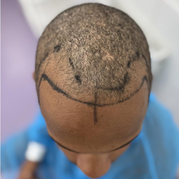 Celebrity Hair Restoration - Love Island Konnor Ewudzi - Hairline Restoration - British Hair Clinic