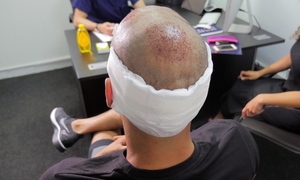 How Many Grafts Do You Need For An Fue Hair Transplant