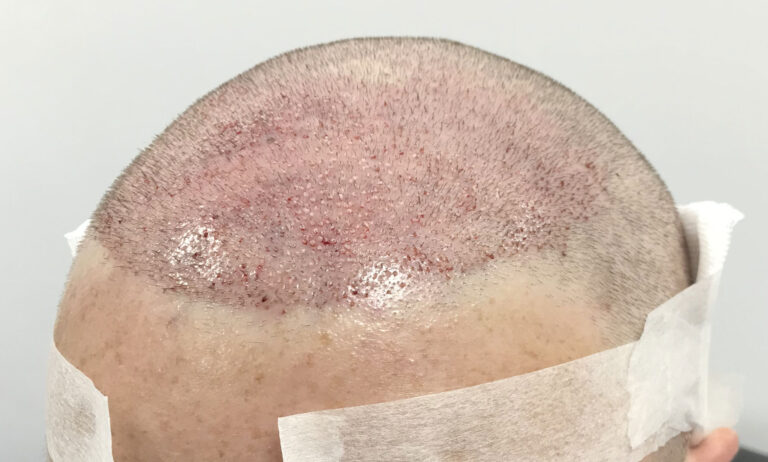 How Many Grafts Do You Need For An FUE Hair Transplant