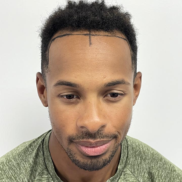 Konnor Ewudzi Hair Loss - Love Island - Hair Restoration - British Hair Clinic
