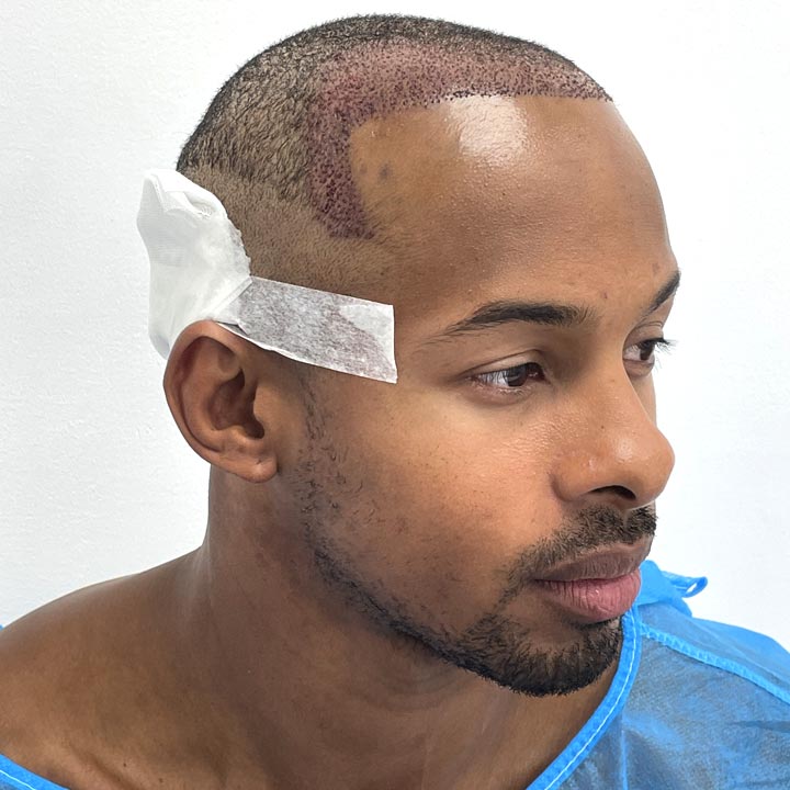 Hairline Restoration - Konnor Ewudzi - FUE Surgery - British Hair Clinic