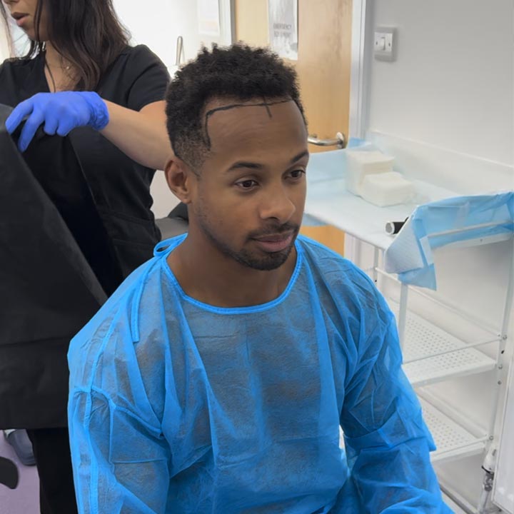 Konnor Ewudzi - Traction Alopecia - Hair Restoration Surgery - British Hair Clinic