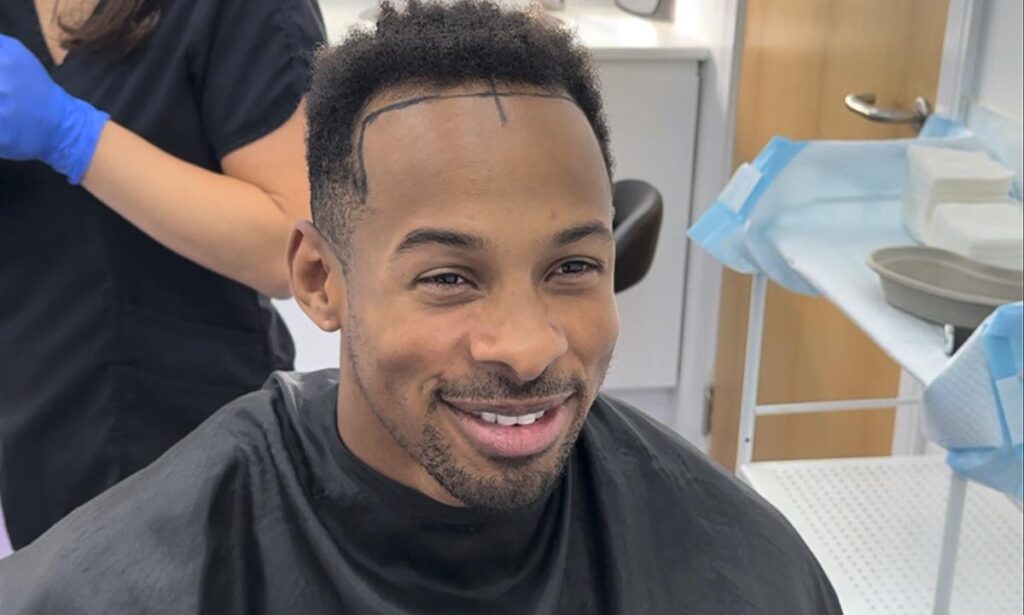 Love Island - Konnor Ewudzi - Hairline Restoration - British Hair Clinic