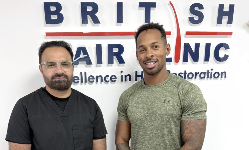 Love Island Hair Transplant - Konnor Ewudzi - FUE Hair Transplant - British Hair Clinic