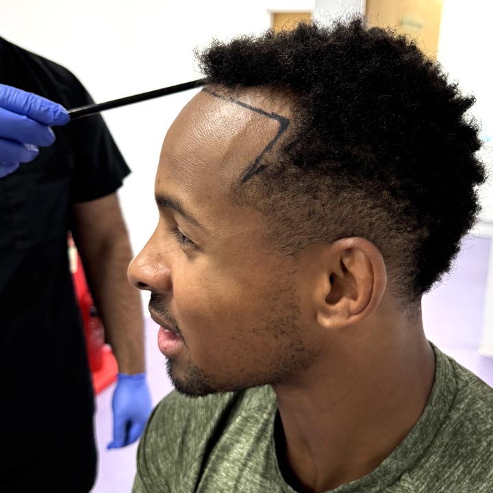 Love Island’s Konnor Ewudzi sharing his hair restoration journey after an FUE hair transplant