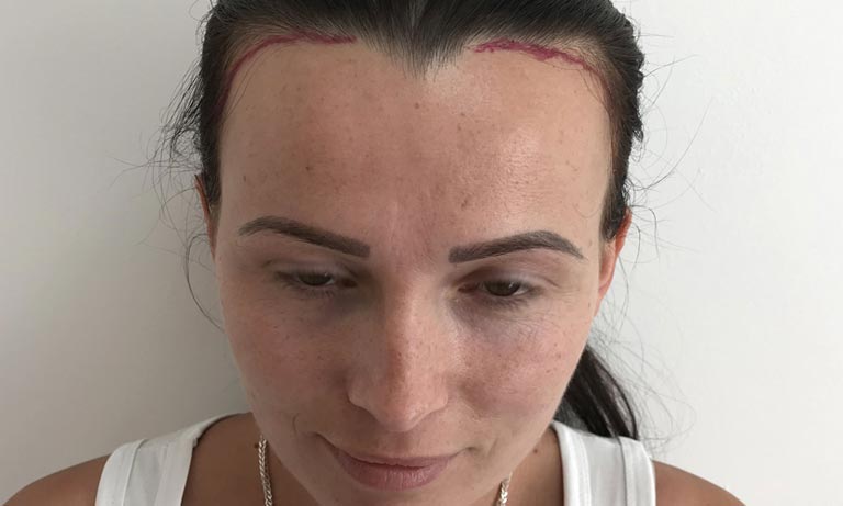 5 Most Common Causes Of Hair Loss In Women