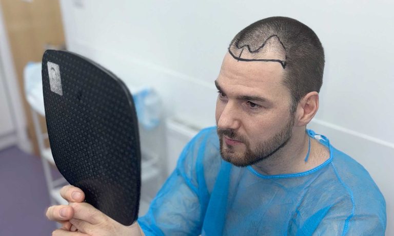 Can A Hair Transplant Be Done Twice